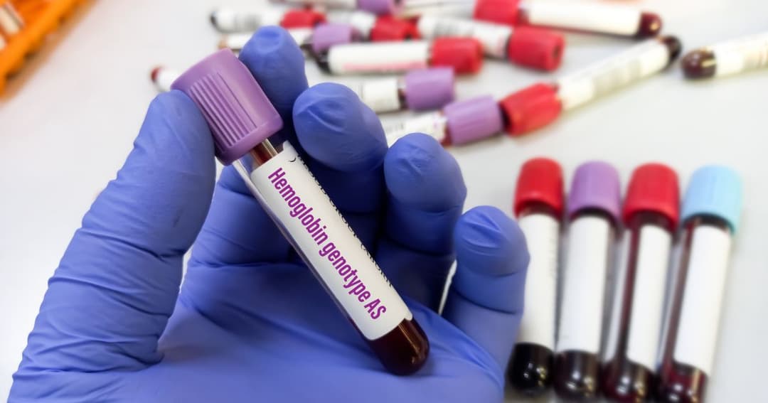 AA, AS, or SS? What Your Genotype Means for You and Your Family